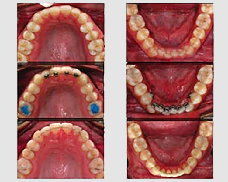 Apparecchio denti Valsamoggia e ortodonzia adulti e bambini