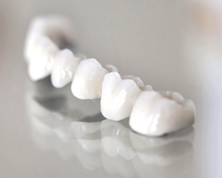 Ponti in zirconio: perché sceglierli rispetto alle altre soluzioni