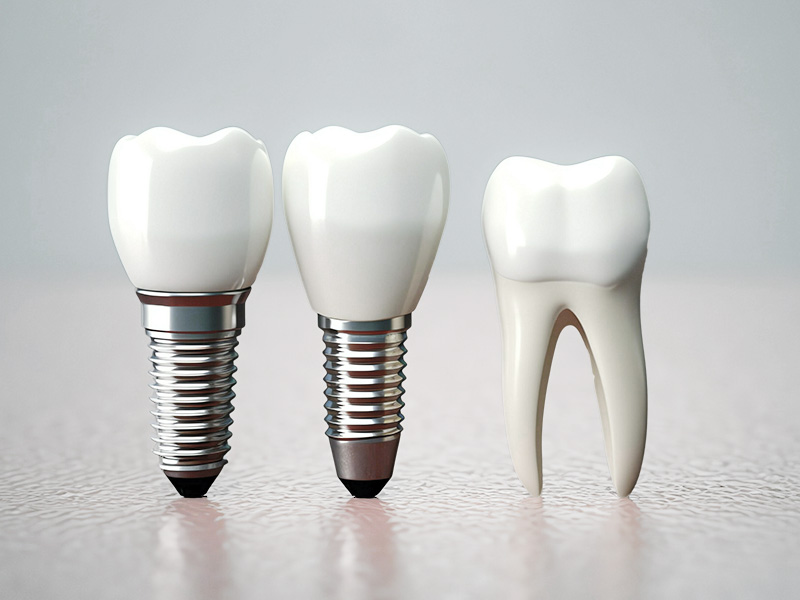 Corone in zirconio: l'innovazione nell'odontoiatria moderna