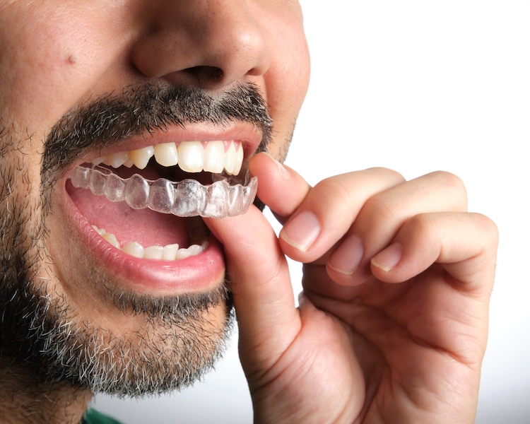 Ortodonzia adulti Valsamoggia: soluzioni moderne per un sorriso armonico