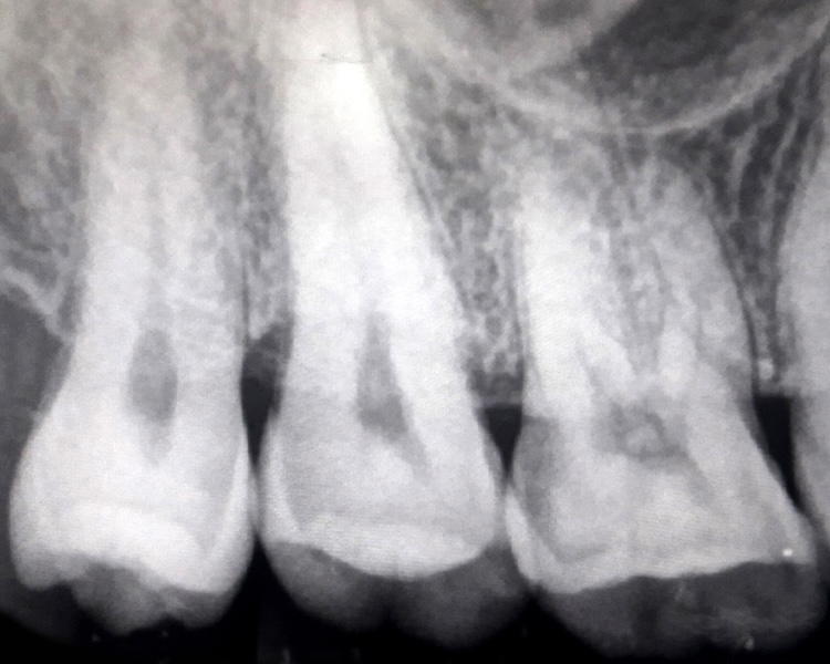 Radiografie endorali Valsamoggia
